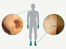 Silhouette of body with hands and feet highlighted; photo inset of melanoma on the face, the other photo inset pointing at melanoma on the sole of a foot