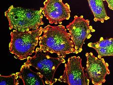 Células de cáncer metastásico