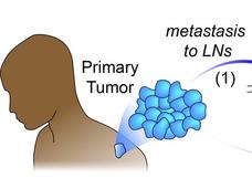 Graphic depicting tumor cells leaving the primary tumor and entering a lymph node. Immune cells leave the lymph node and enter the lungs and liver.