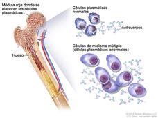 en la ilustración, se muestran células plasmáticas normales, células de mieloma múltiple (células plasmáticas anormales) y anticuerpos. También se muestra la médula roja en el hueso, en donde se elaboran las células plasmáticas.