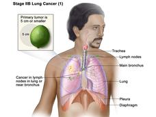 Stage III B lung cancer is 5cm or smaller--about the size of a lime.