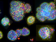 Immunofluorescence images of micro-organospheres created from a human lung tumor.