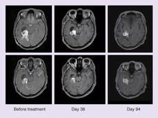 MRI scans of BRAF-positive brain tumors after dabrafenib and trametinib treatment.