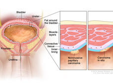 Anatomic illustration of two forms of non-muscle-invasive bladder cancer