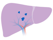 An illustration of a liver with 3 tumors, each less than 5 cm in size.