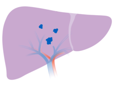 drawing of liver with 3 small lesions