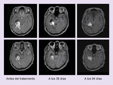 Imágenes por resonancia magnética de dos personas que tienen tumores de encéfalo con BRAF tratados con dabrafenib y trametinib (paciente 1, arriba; paciente 2, abajo).