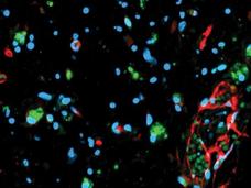 A fluorescence micrograph of glioma organoids.