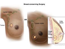 2 anatomy pictures of the breast. 1 shows  a tumor in the breast with lymph nodes under the arm. There is a circle around the tumor in the breast. The other shows a tumor in the breast and the lymph nodes under the arm. There is a circle around the breast tumor and a circle around the lymph nodes.