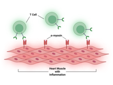 An illustration of T cells attacking inflamed heart tissue by binding to alpha-myosin.