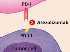 Graphic showing how atezolizumab blocks tumor cells' ablity to evade the immune system by blocking the binding of two checkpoint inhibitors, PD-1 and PD-L1. 