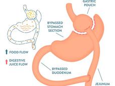 In a Roux-en-Y gastric bypass, staples are placed in the stomach, creating a small pouch in the upper section, and part of the small intestine is divided and attached directly to the small stomach pouch.