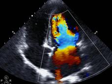 A doppler echocardiogram measures blood flow in the heart.