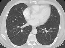 A pair of black and white CT scans. The scan at the top shows a large lesion in a cross-section of the lungs. The scan at the bottom shows the same cross-section of the lungs but with the lesion mostly gone. 