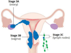 Anatomic illustration of stage 3a, 3b, and 3c endometrial cancer 