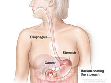 Barium swallow for stomach cancer; drawing shows barium liquid flowing through the esophagus and into the stomach.