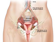 El dibujo muestra un cáncer de endometrio en estadio IIIC, en una sección transversal del útero, el cuello uterino, las trompas de Falopio, los ovarios y la vagina.