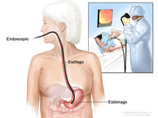 Endoscopia superior. En la imagen se observa un endoscopio (tubo delgado con una luz) que se introduce por la boca y la garganta hasta llegar al esófago y  el estómago. El recuadro muestra una paciente acostada en una camilla mientras se le hace una endoscopia superior.