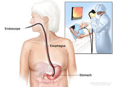 Upper endoscopy; drawing shows an endoscope (a thin, lighted tube) inserted through the mouth and down the throat into the esophagus and stomach. An inset shows a patient on a table having an upper endoscopy.