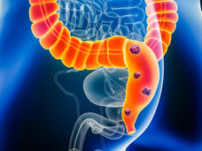 A 3-D illustration of anatomy in the lower abdomen of a male showing tumors in the colon and rectum.