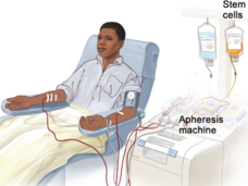 illustration of person hooked up to an apheresis machine