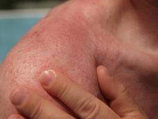 close up of a white person's shoulder that is covered with a rash