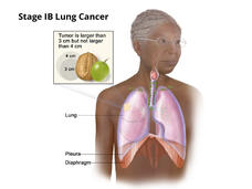 An illustration of stage 1B lung cancer