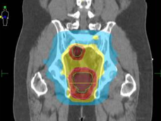 Plan de dosificación de radioterapia de intensidad modulada para un adulto con cáncer de recto.