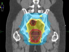 An IMRT dosing plan for an adult with rectal cancer