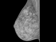 A mammogram with arrows indicating an asymmetry in the upper area of the breast.