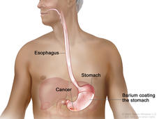 Barium swallow; drawing shows barium liquid flowing down the esophagus and into the stomach. The barium coats and outlines the inside of the esophagus and stomach. Also shown is cancer in the stomach.