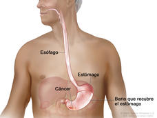 Estudio con ingesta de bario. En el dibujo se observa el tronco y la cabeza de un hombre mayor. Además, se ve bario líquido que pasa por el esófago hasta el estómago. El bario recubre y resalta el interior del esófago y el estómago. También se observa cáncer de estómago.