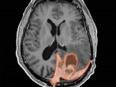 An imaging scan of a brain with a meningioma highlighted in orange.
