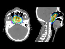 Imaging scans of a nasopharyngeal carcinoma with radiation doses presented in different colors