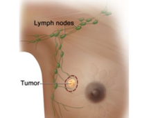 An illustration of a small tumor in a breast and nearby lymph nodes in the armpit.