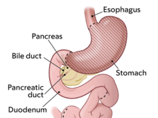 Two medical illustrations of gastrointestinal anatomy. One illustration shows normal GI anatomy with dotted lines where incisions are made during total gastrectomy surgery, and the other shows GI anatomy after a total gastrectomy.