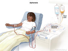 Woman sits in chair attached to an apheresis machine. The needle in one arm removes blood where it flows into the apheresis machine. Then, another needle carries blood from the apheresis machine into her other arm.