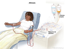 Ilustración que muestra a una mujer durante la aféresis. En un brazo, se extrae sangre que pasa a la máquina de aféresis que separa las células madre. En el otro brazo, se devuelve la sangre que pasó por la máquina de aféresis.