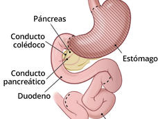 Dos ilustraciones médicas que muestran el sistema gastrointestinal antes y después de extirpar del estómago. A la izquierda, la ilustración muestra la anatomía gastrointestinal normal con líneas de puntos donde se hacen los cortes durante la gastrectomía total; la ilustración de la derecha muestra la anatomía gastrointestinal sin el estómago.