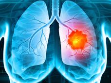 A stylized chest x-ray illustration showing a bright orange tumor in the right lung.