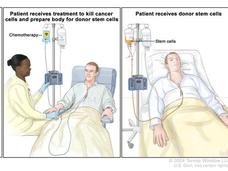 3 panels showing the stem cell transplant process 