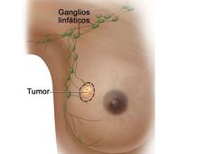 Imagen de una mama (seno) que muestra un tumor y la ubicación de los ganglios linfáticos cercanos.