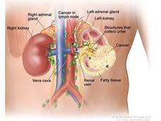 An anatomic illustration of stage 3 kidney cancer