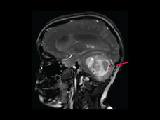 An MRI scan showing a side view of a child with a low-grade glioma in the lower back of the brain. 