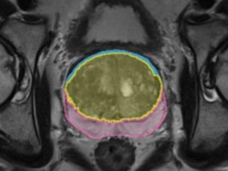 MRI image of the prostate showing segmentation of the core and peripheral zones.