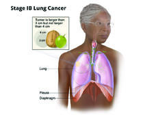 An illustration of stage 1B lung cancer