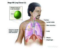 An anatomic illustration of stage 2b nonsmall cell lung cancer