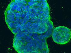 Three-dimensional culture of human breast cancer cells, with DNA stained blue and a protein in the cell surface membrane stained green. 