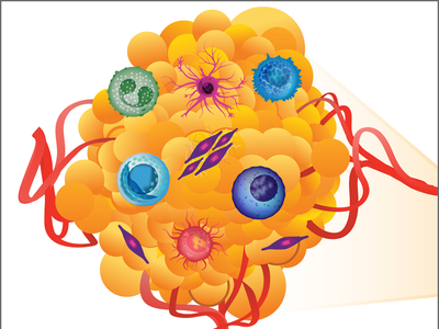 Ilustración gráfica de un tumor (amarillo) que incluye los componentes del microambiente tumoral: célula dendrítica (rosada), un linfocito (azul), fibroblastos (en rosa oscuro con borde morado), un linfocito citolítico natural (azul oscuro), un linfocito regulador (celeste), vasos sanguíneos (rojos), un macrófago (rojo con centro amarillo) y una célula mieloide (verde)