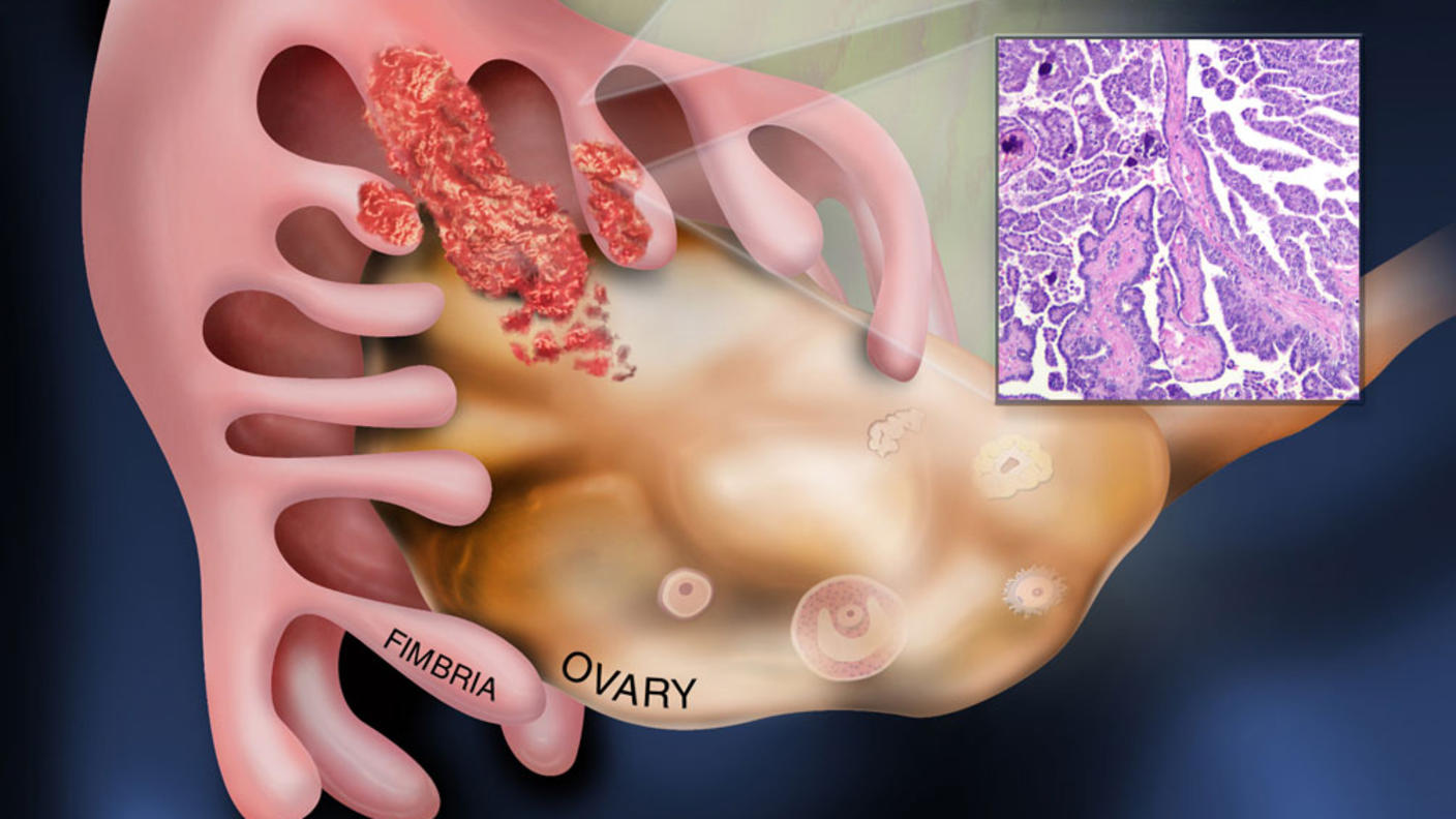 Illustration showing ovarian cancer starting in the fallopian tube